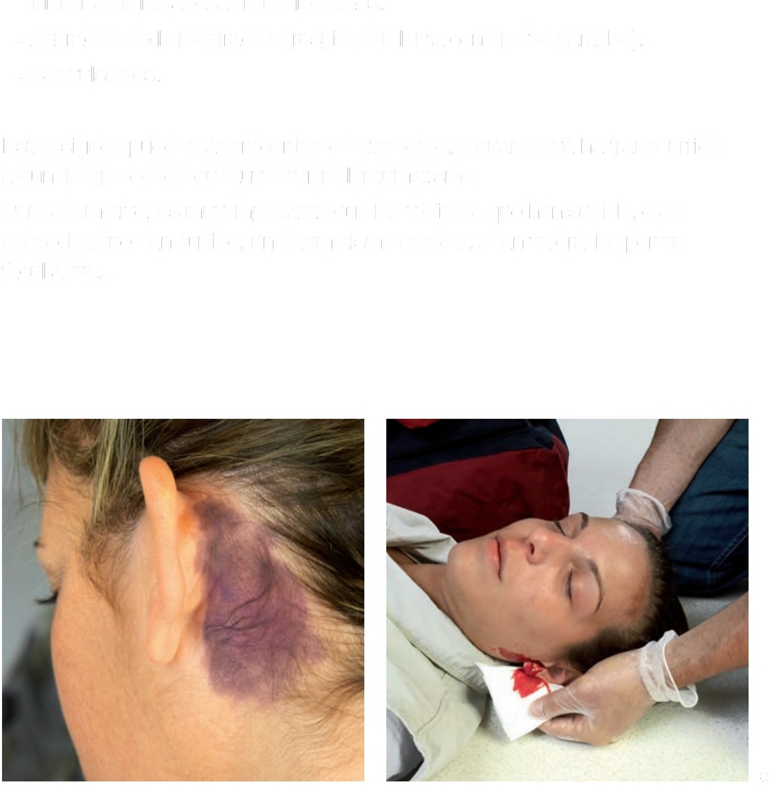 Imagen del PowerPoint mostrando traumatismo craneal y hemorragia